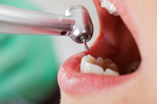 Best Emergency Dental Care for Broken or Chipped Teeth in Auburn, NE